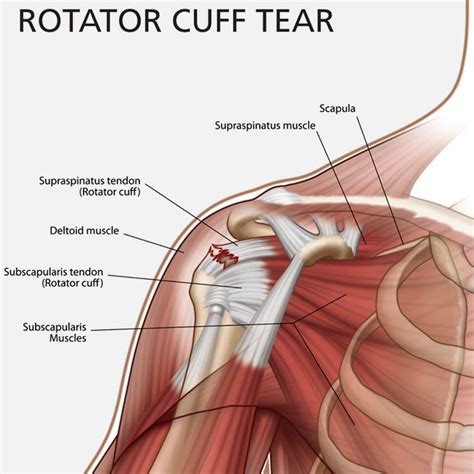 Rotator Cuff Injury : Physical Therapy and Surgery | Rotator cuff tear, Rotator cuff surgery ...