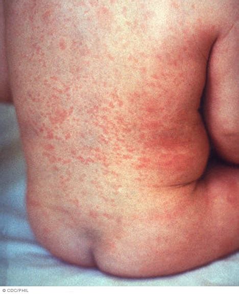 Understanding German Measles: Symptoms, Causes, And Treatment - Ask The ...