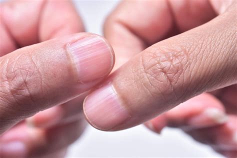 What Causes Ridges in Fingernails | Daily Dose