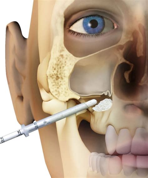 Sinus lift surgery for Dental Implants - Omnia Dental Clinic