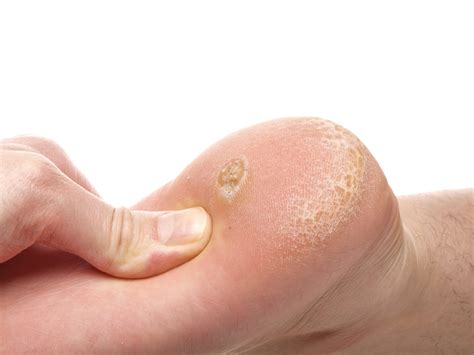 What’s the Difference Between Foot Corns vs Foot Calluses? - Foot and ...