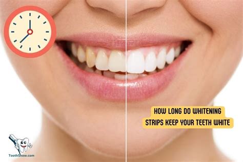 How Long Do Whitening Strips Keep Your Teeth White? 6 Months