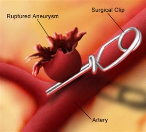 Brain Aneurysm | Brain Aneurysm Treatments