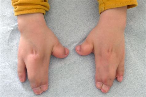 Apert syndrome: Symptoms, treatment, and prognosis