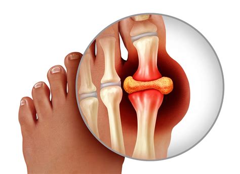 Gout - Symptoms, Treatment & Causes | MyHealthcare Clinic