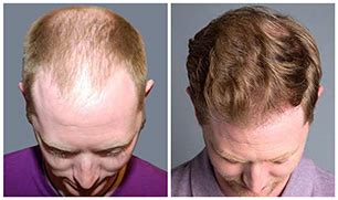 Treatment Options for Hair Loss - Bosley Hair Transplant