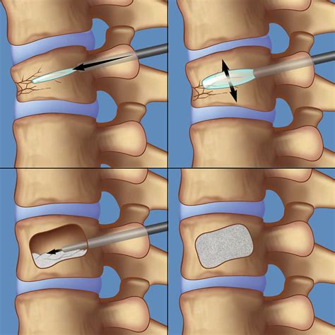 Surgery for Spinal Compression Fractures | Weill Cornell Brain and ...