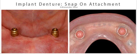 Snap On Dentures - Solution for Loose Lower Dentures