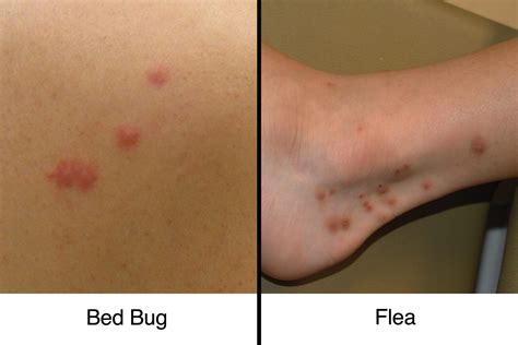 Do Bed Bug Bites Look Like Flea Bites - Pest Phobia