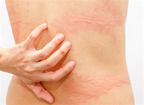 What is urticaria? - RefLab ApS