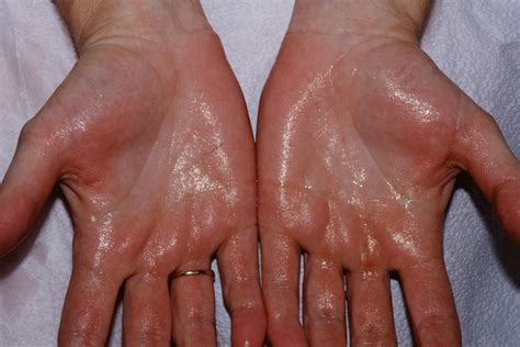 All You Need To Know About Hyperhidrosis - Causes, Symptoms And Treatments