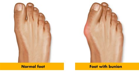 Bunion Pain – Common Causes and Symptoms | Stryker