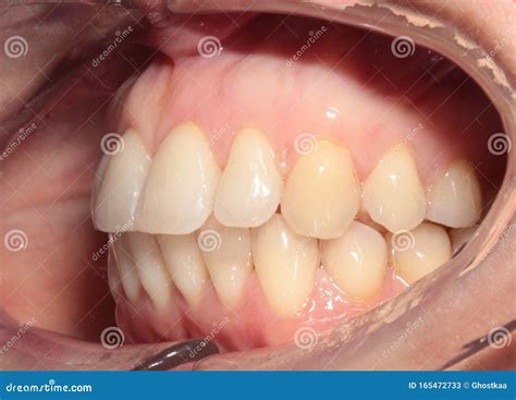 Vista Lateral De Los Dientes Después De La Corrección Por Llaves Dentales Imagen de archivo ...