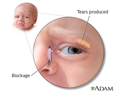 Blocked tear duct Information | Mount Sinai - New York