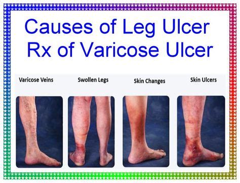 Causes of leg ulcer Rx of varicose ulcer in 2020 | Leg ulcers, Varicose ...