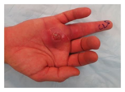 Tenosynovitis of the flexor digitorum superficialis (FDS) and flexor... | Download Scientific ...