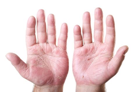 Eczema On Top Of Hands