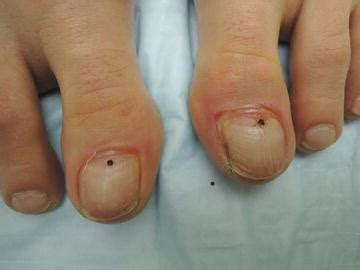 Subungual Hematoma Vs Melanoma