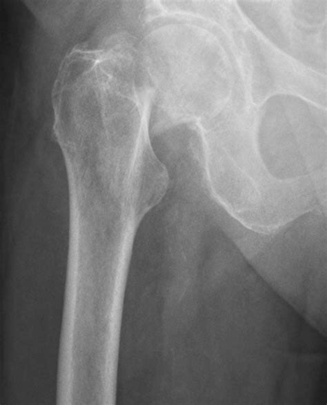 Hip Fracture – Femoral Neck Fracture – Undergraduate Diagnostic Imaging Fundamentals