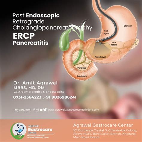 Post Endoscopic retrograde cholangiopancreatography (ERCP) Pancreatitis, Symptoms, Causes, Treatment