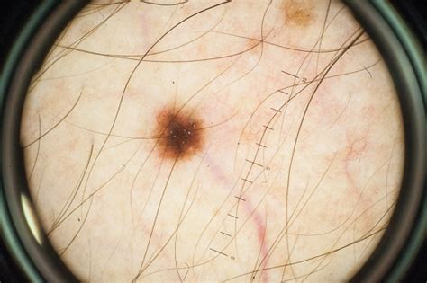 Magnification Of Skin Mole Through Dermatoscope Stock Photo - Download Image Now - Angled Mirror ...