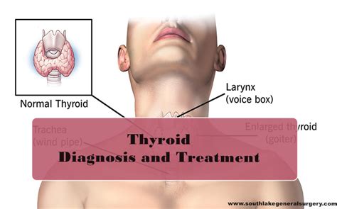 Thyroid Problem Diagnosis and Treatment - Southlake General Surgery