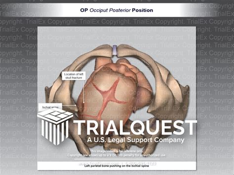 OP (Occiput Posterior) Position - TrialExhibits Inc.