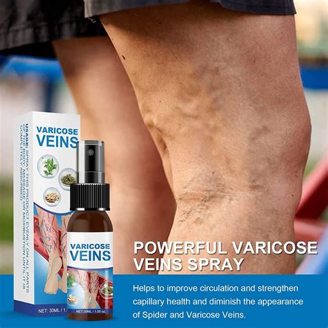 Varicose Veins Miracle Spray: Treatment for Legs to Improve Blood Circulation, Soothe Spider ...