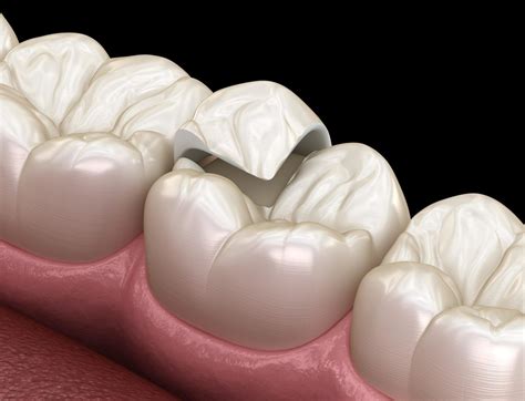 What Are Inlays and Onlays Treatment? | 3D Dentistry in Bradenton, FL