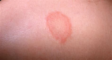 Ringworm in babies: what is it and how to treat it | BabyCenter