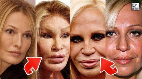 Plastic Surgery Gone Wrong Celebrities Before And After