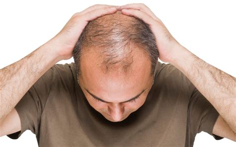 What causes male pattern baldness - superliving