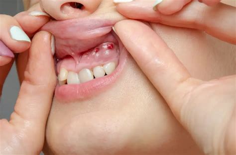 How To Treat A Dental Cyst At Home? (Easy To Follow)