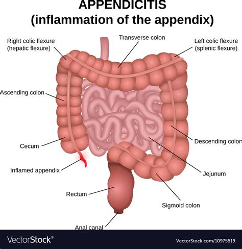 Inflammation of the appendix Royalty Free Vector Image