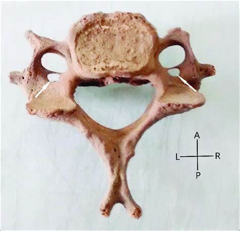 Arrows showing Accessory foramen transversarium on both sides of C5... | Download Scientific Diagram