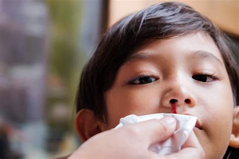 How To Stop Nosebleeds At Home