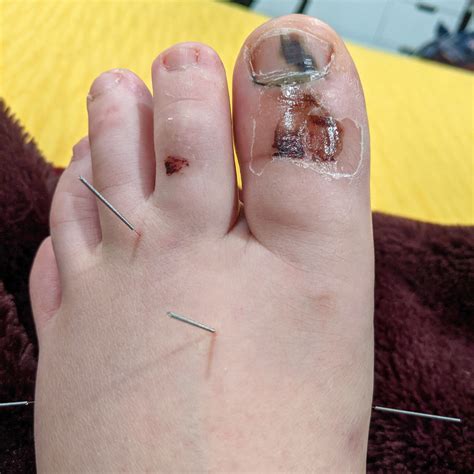 Traditional Chinese Medicine Case Report: Broken Big Toe — Alina Rehkopf