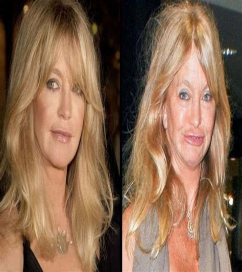 60 Worst Cases Of Celebrity Plastic Surgery Gone Wrong 8E9