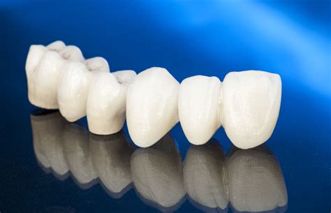 All Ceramic Crowns | London Dental Implant | Dentagama