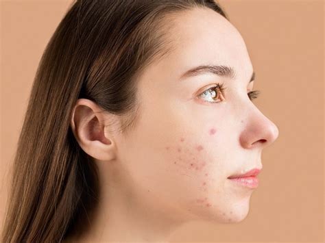 Things you should never do if you don't want acne