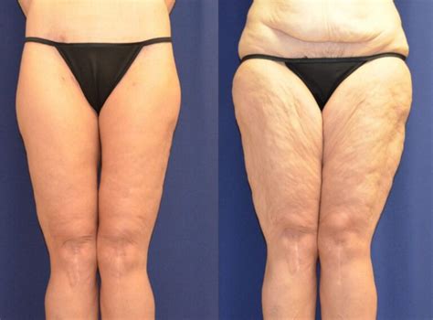 Coolsculpting vs Lipo