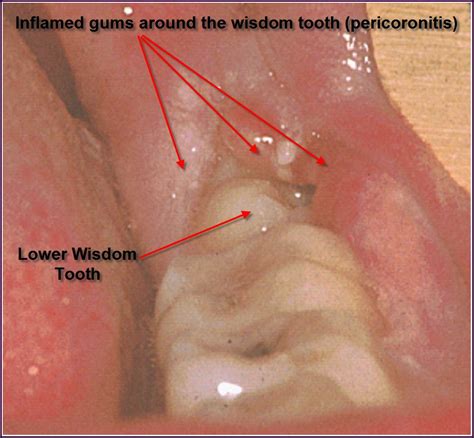 FAMILY CARE DENTAL: WISDOM TEETH