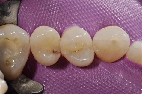 Case-323 | Tam Dental Group