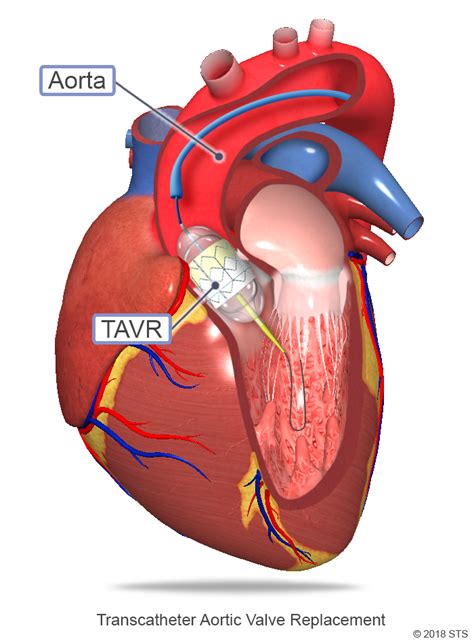 TAVR: Innovation in Cardiology - MozartCultures Science