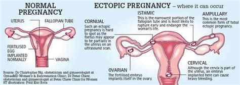 Apakah yang dimaksud Kehamilan Ektopik? - Kebidanan - Dictio Community