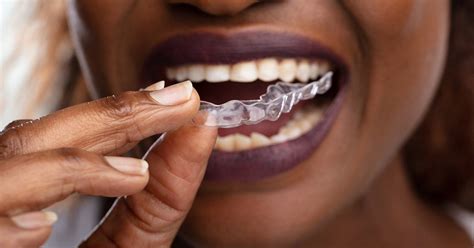 Understanding What's Involved in the Invisalign Process