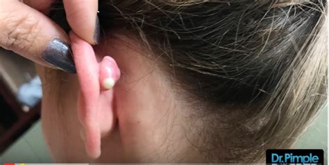 Watch Dr. Pimple Popper Blast This MASSIVE Growth Behind Woman’s Ear [VIDEO] | John Hawkins ...