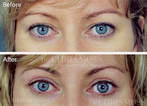 Eyelid Surgery Before & After | Dr Chris Moss Plastic Surgeon