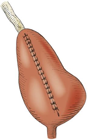 Bladder Flap Repair (Boari) | Abdominal Key