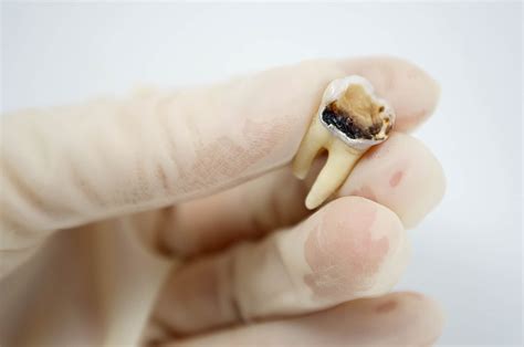 What is a Dead Tooth? Symptoms, Causes & Treatments